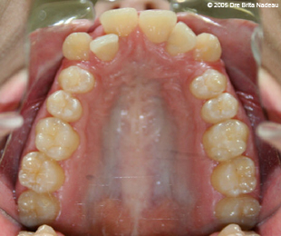 Marie-Hélène Cyr - Upper occlusal view - Before orthodontic treatments and orthognathic surgeries (November 24, 2005)